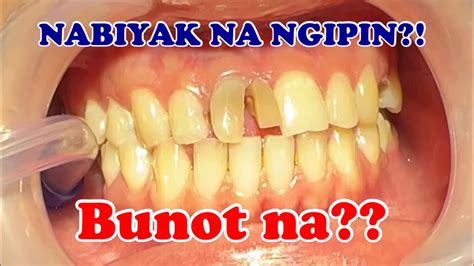 pa bunot ng ngipin in english|How to Say “Bunot ng Ngipin” in English: A Comprehensive Guide.